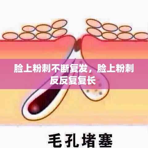 脸上粉刺不断复发,脸上粉刺反反复复长