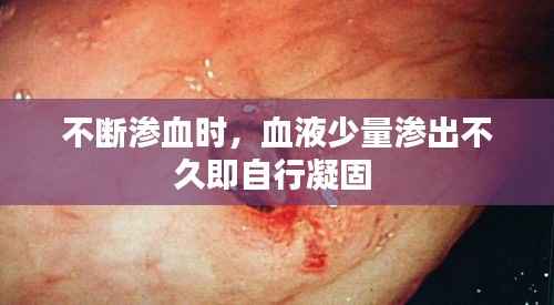 不断渗血时,血液少量渗出不久即自行凝固