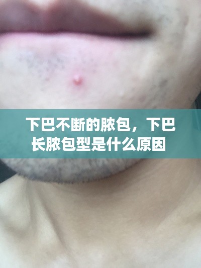 下巴不断的脓包,下巴长脓包型是什么原因